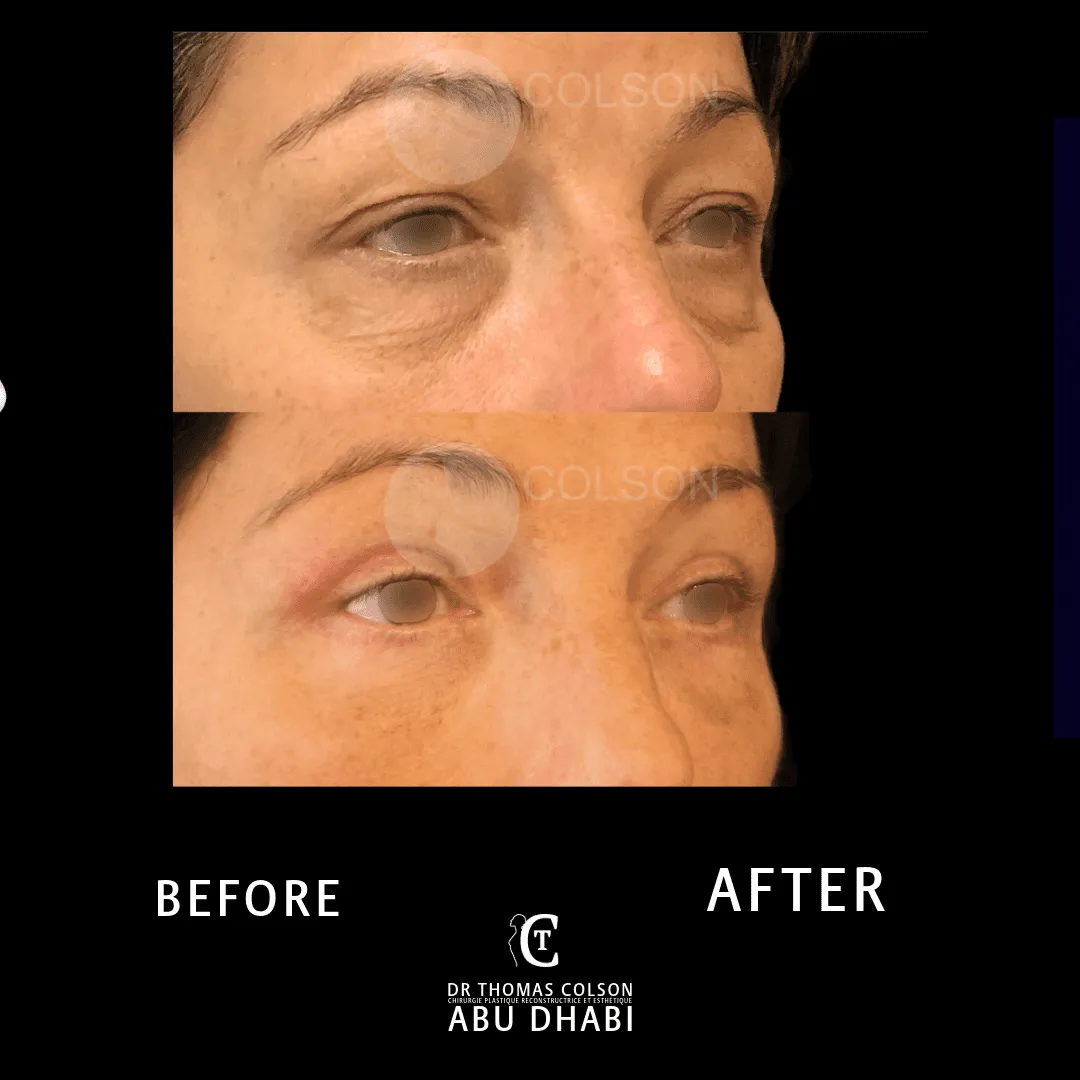 مقارنة فوتوغرافية قبل وبعد، جراحة الجفون (Blepharoplasty)، لقطة مقرّبة للجفون. الحالة BL-01.