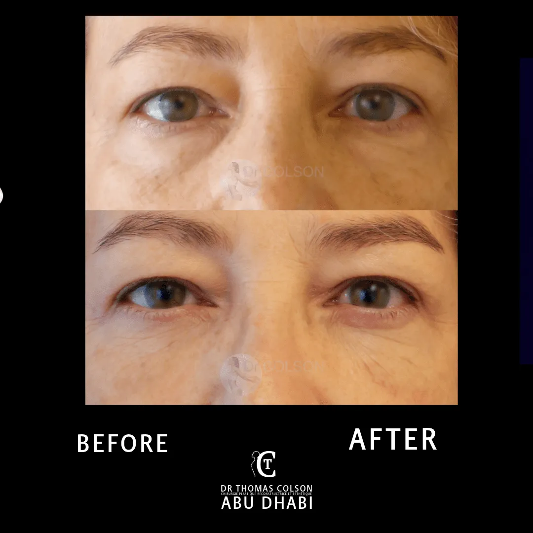 مقارنة فوتوغرافية قبل وبعد، جراحة الجفون (Blepharoplasty)، لقطة مقرّبة للجفون. الحالة BL-02.