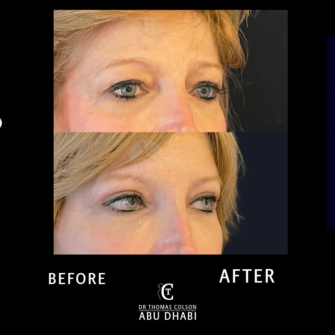 مقارنة فوتوغرافية قبل وبعد، جراحة الجفون (Blepharoplasty)، لقطة مقرّبة للجفون. الحالة BL-03.