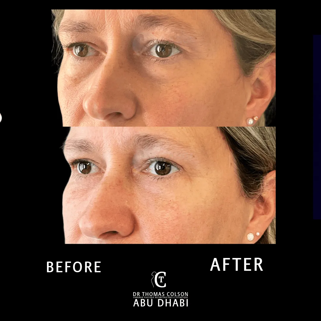 مقارنة فوتوغرافية قبل وبعد، جراحة الجفون (Blepharoplasty)، لقطة مقرّبة للجفون. الحالة BL-04.