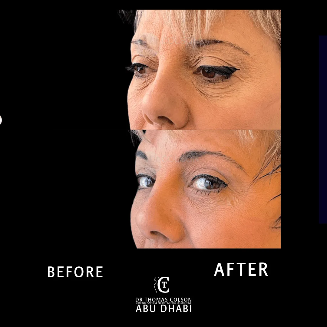مقارنة فوتوغرافية قبل وبعد، جراحة الجفون (Blepharoplasty)، لقطة مقرّبة للجفون. الحالة BL-05.