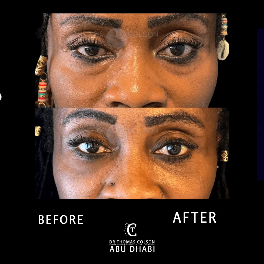 مقارنة فوتوغرافية قبل وبعد، جراحة الجفون (Blepharoplasty)، لقطة مقرّبة للجفون. الحالة BL-06.