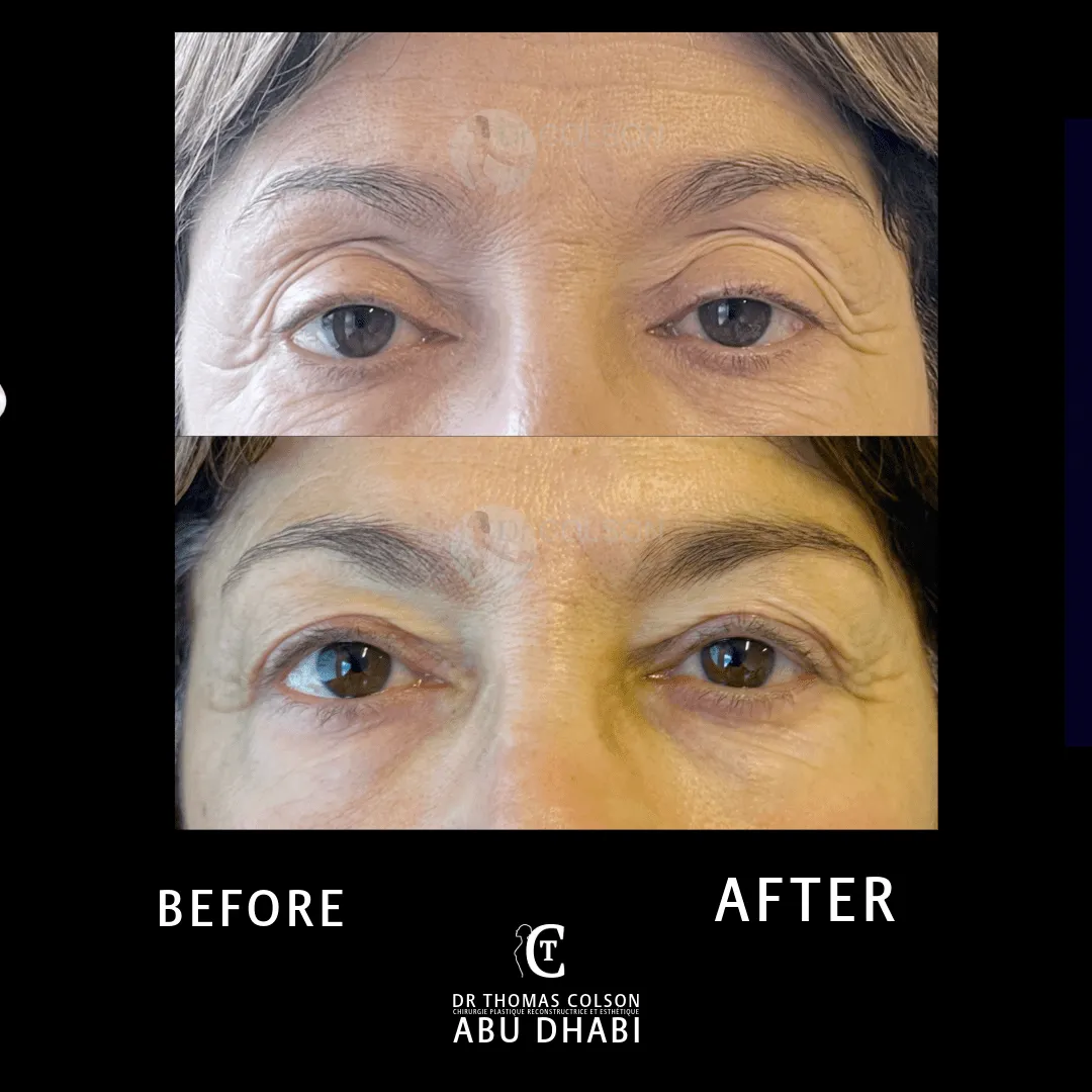مقارنة فوتوغرافية قبل وبعد، جراحة الجفون (Blepharoplasty)، لقطة مقرّبة للجفون. الحالة BL-07.