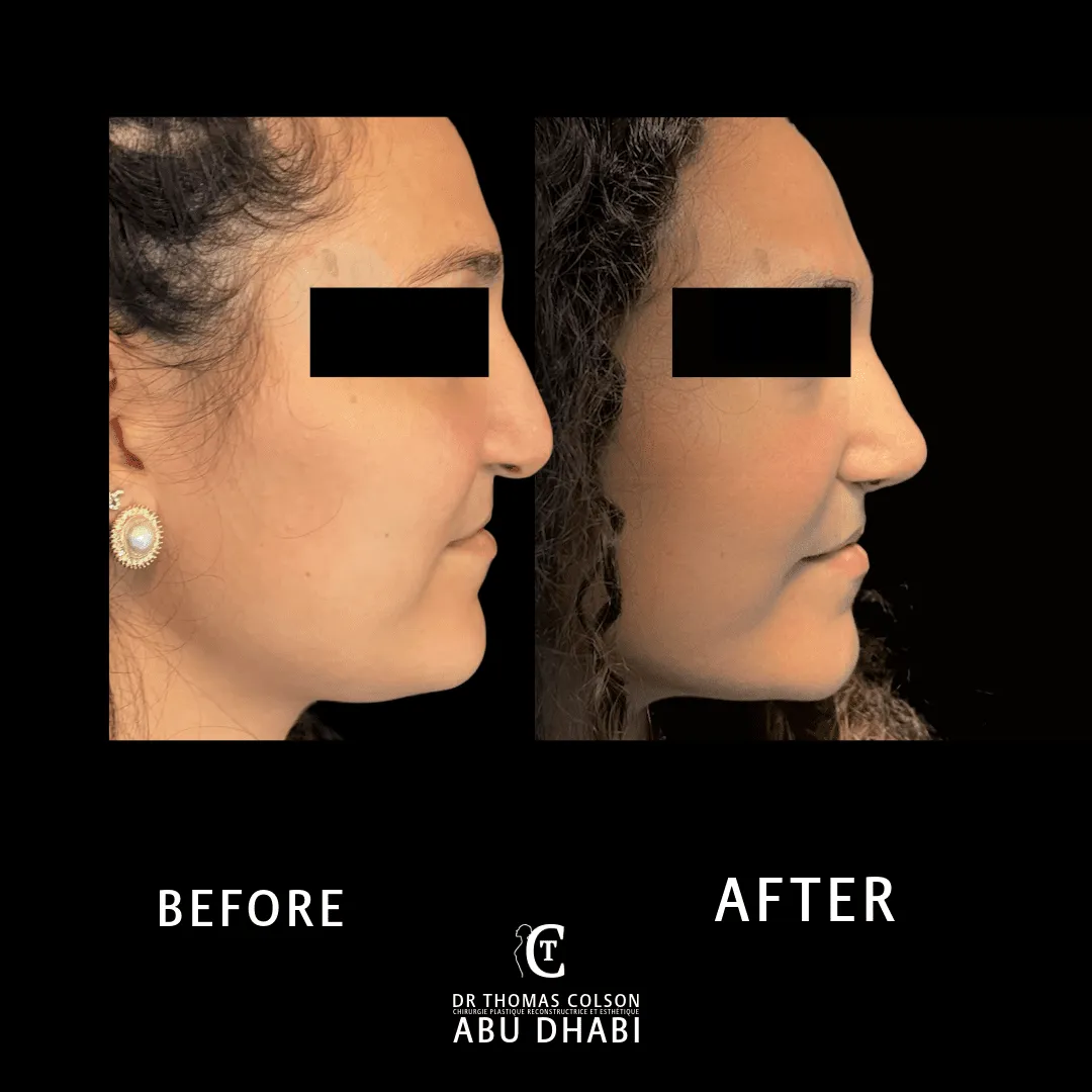 مقارنة فوتوغرافية قبل وبعد، تجميل أنف الشفة الأرنبية (Cleft Nose Rhinoplasty)، منظر جانبي. الحالة CN-01.