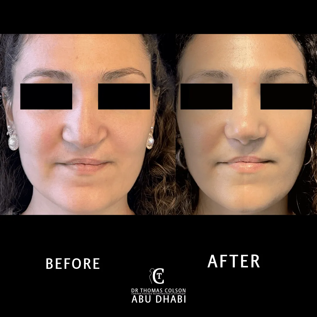 مقارنة فوتوغرافية قبل وبعد، تجميل أنف الشفة الأرنبية (Cleft Nose Rhinoplasty)، منظران أمامي وثلاثة أرباع. الحالة CN-02.