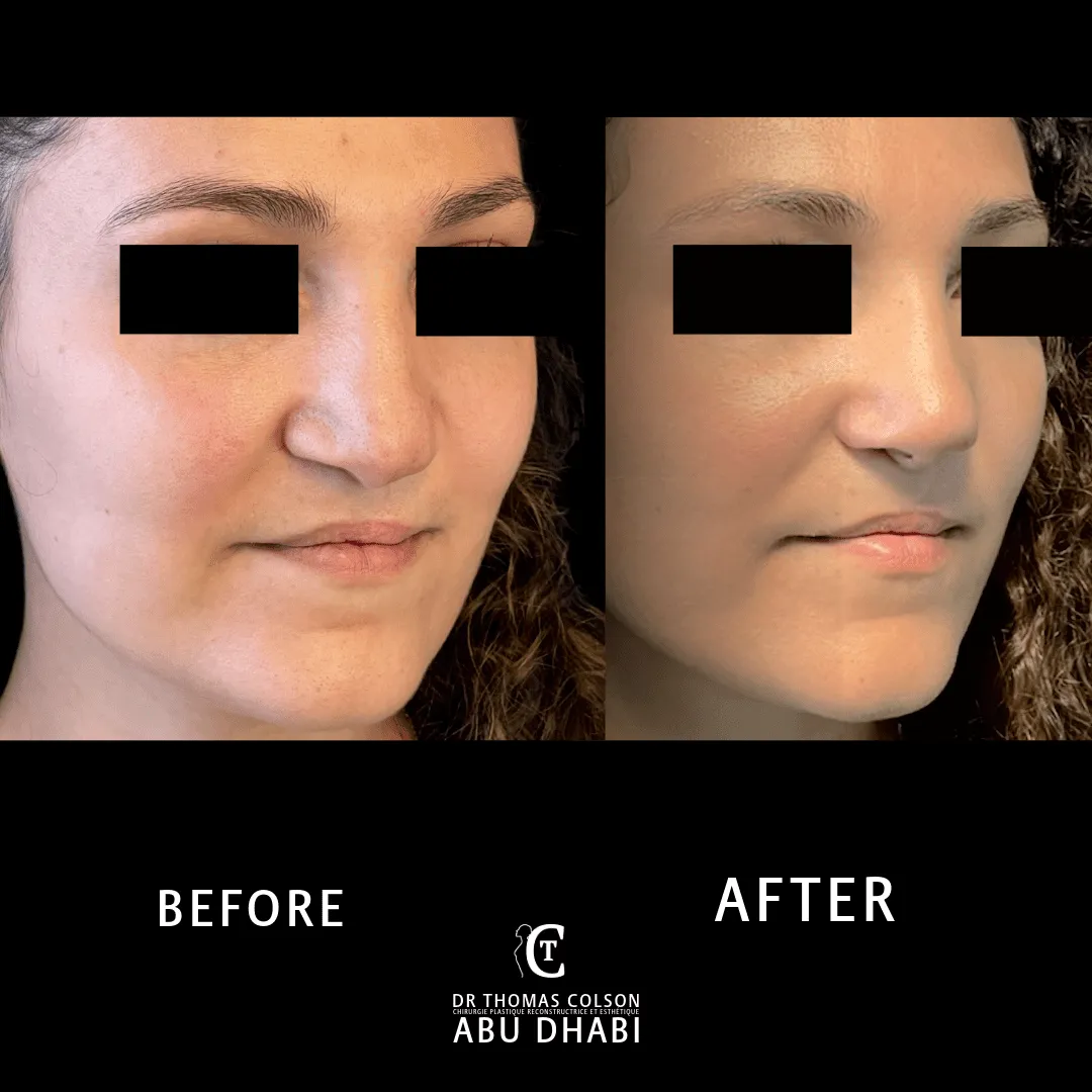 مقارنة فوتوغرافية قبل وبعد، تجميل أنف الشفة الأرنبية (Cleft Nose Rhinoplasty)، منظران أمامي وثلاثة أرباع. الحالة CN-03.