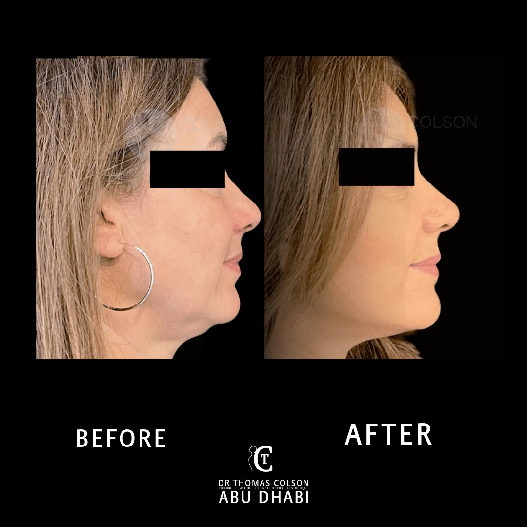 مقارنة فوتوغرافية قبل وبعد، شد الوجه العميق (Deep Plane Facelift)، منظر جانبي. الحالة DPF-01.