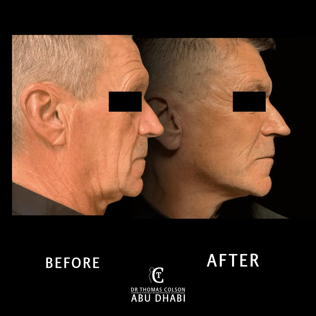 مقارنة فوتوغرافية قبل وبعد، شد الوجه العميق (Deep Plane Facelift)، منظر جانبي. الحالة DPF-02.