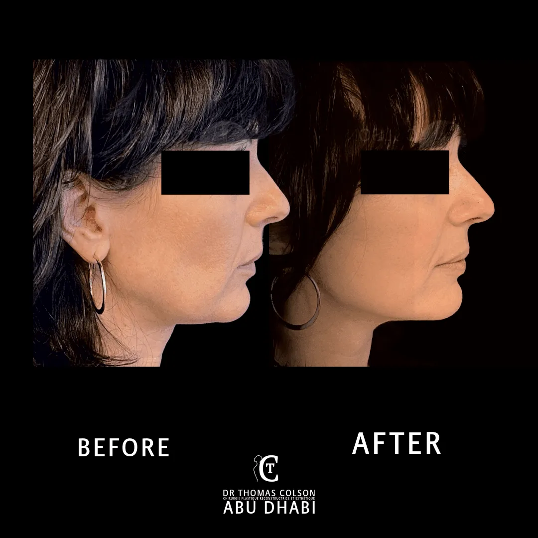 مقارنة فوتوغرافية قبل وبعد، شد الوجه العميق (Deep Plane Facelift)، منظر جانبي. الحالة DPF-03.