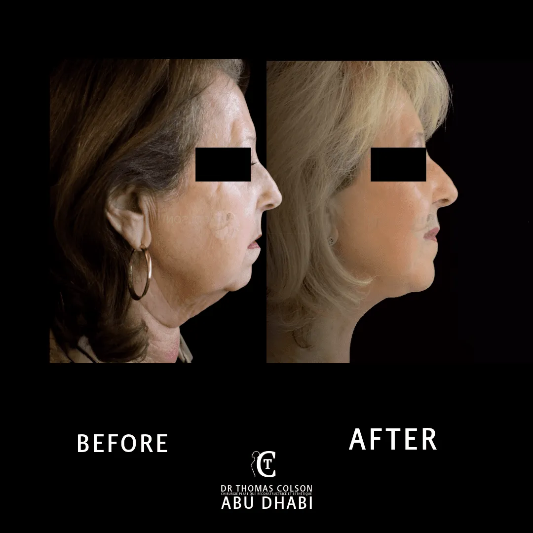 مقارنة فوتوغرافية قبل وبعد، شد الوجه العميق (Deep Plane Facelift)، منظر جانبي. الحالة DPF-04.