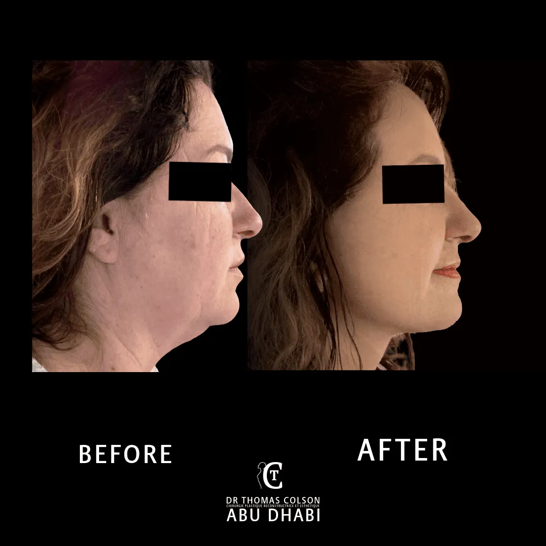 مقارنة فوتوغرافية قبل وبعد، شد الوجه العميق (Deep Plane Facelift)، منظر جانبي. الحالة DPF-05.