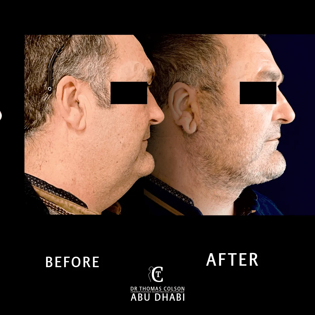 مقارنة فوتوغرافية قبل وبعد، شد الوجه العميق (Deep Plane Facelift)، منظر جانبي. الحالة DPF-06.