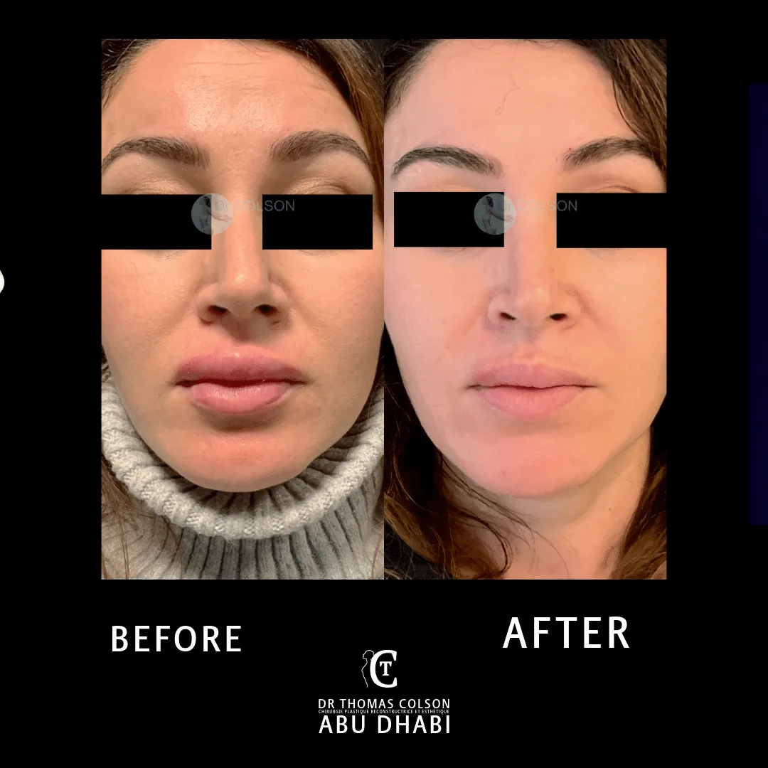 مقارنة فوتوغرافية قبل وبعد، الفيلر الجلدي (Dermal Fillers)، منظر ثلاثة أرباع. الحالة HY-01.