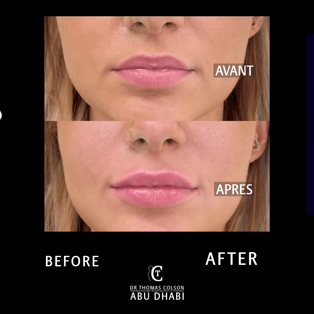 مقارنة فوتوغرافية قبل وبعد، الفيلر الجلدي (Dermal Fillers)، لقطة مقرّبة للشفتين. الحالة LP-01.