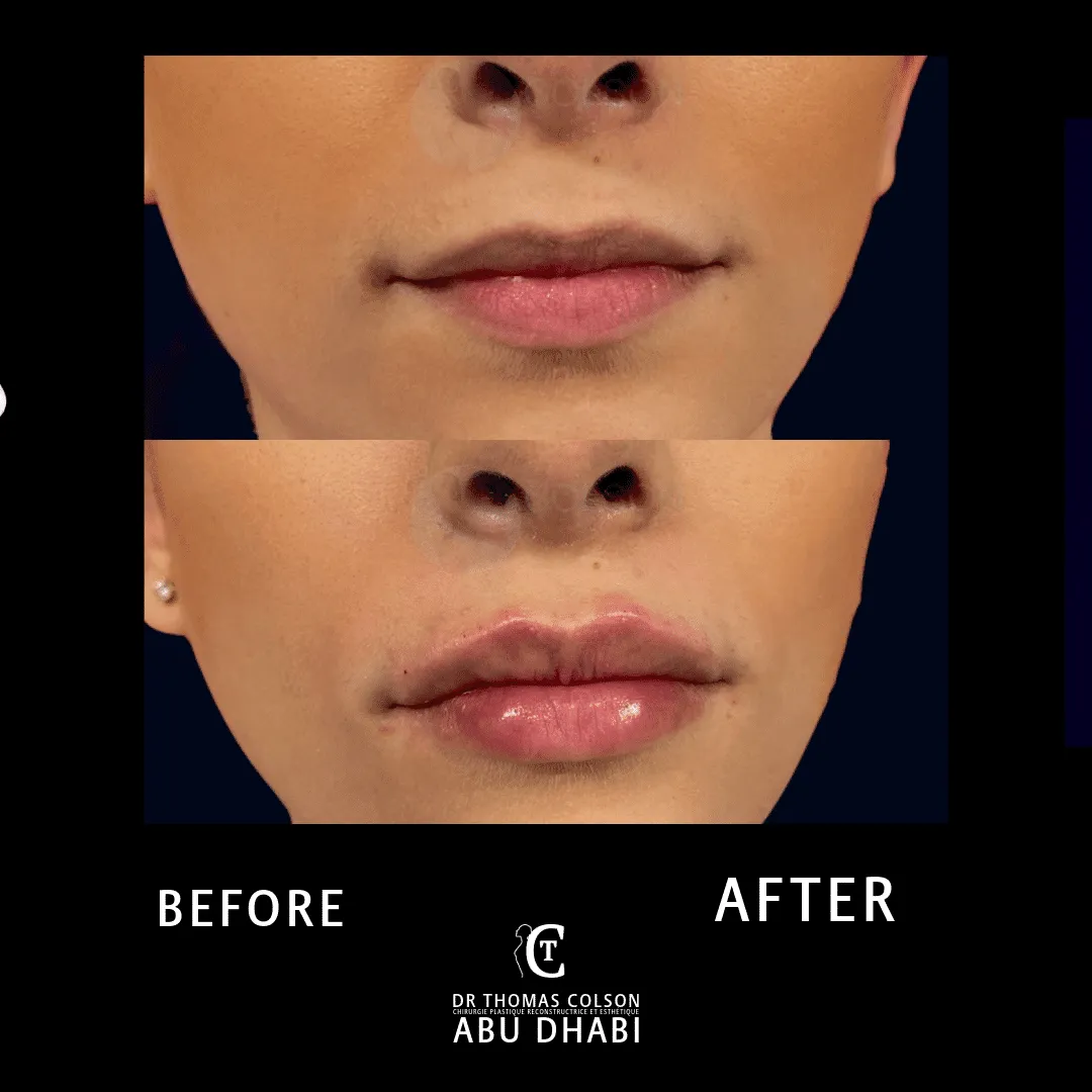 مقارنة فوتوغرافية قبل وبعد، الفيلر الجلدي (Dermal Fillers)، لقطة مقرّبة للشفتين. الحالة LP-02.