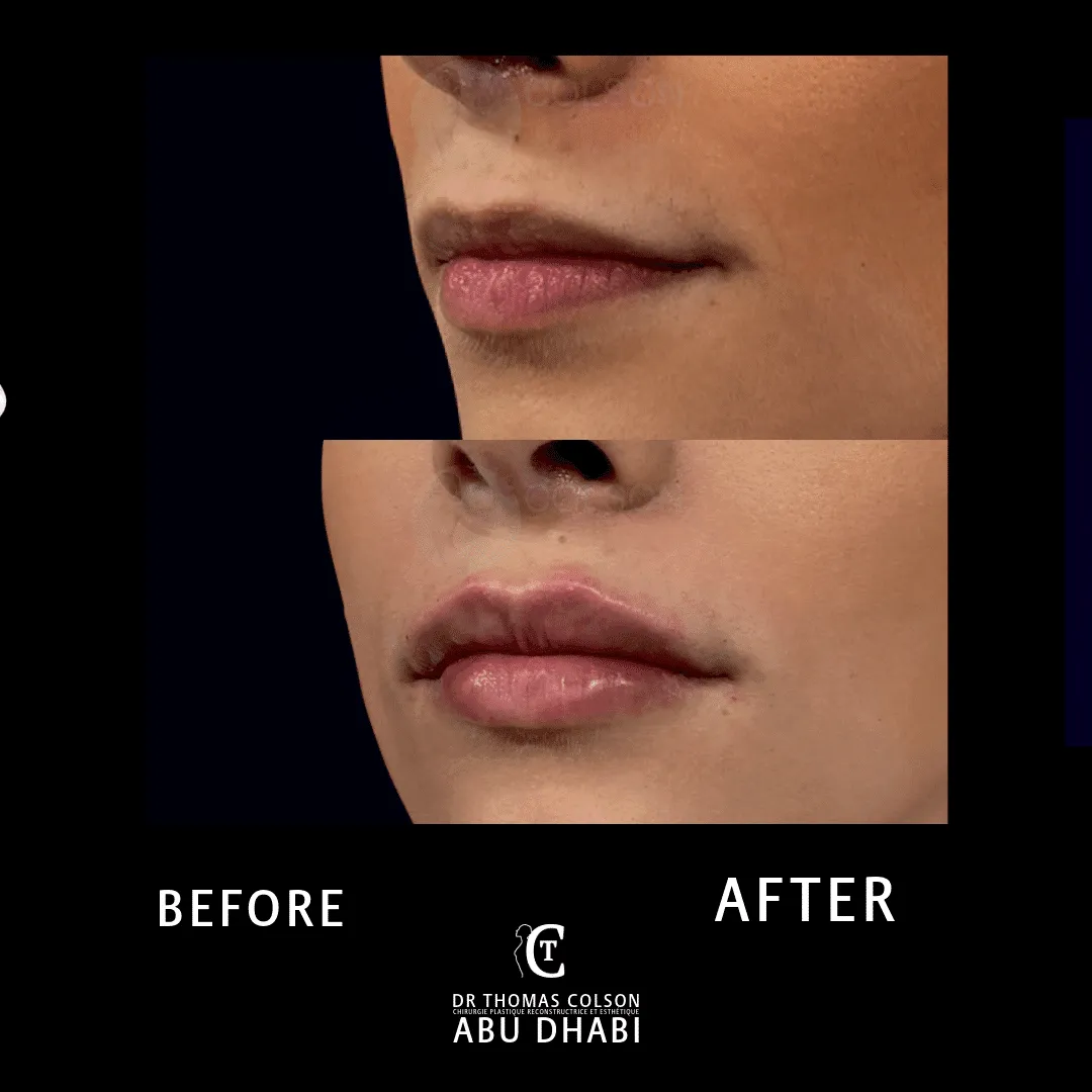 مقارنة فوتوغرافية قبل وبعد، الفيلر الجلدي (Dermal Fillers)، لقطة مقرّبة للشفتين. الحالة LP-03.