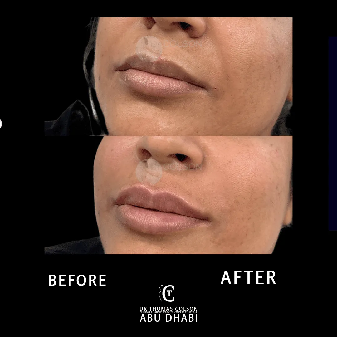 مقارنة فوتوغرافية قبل وبعد، الفيلر الجلدي (Dermal Fillers)، لقطة مقرّبة للشفتين. الحالة LP-04.