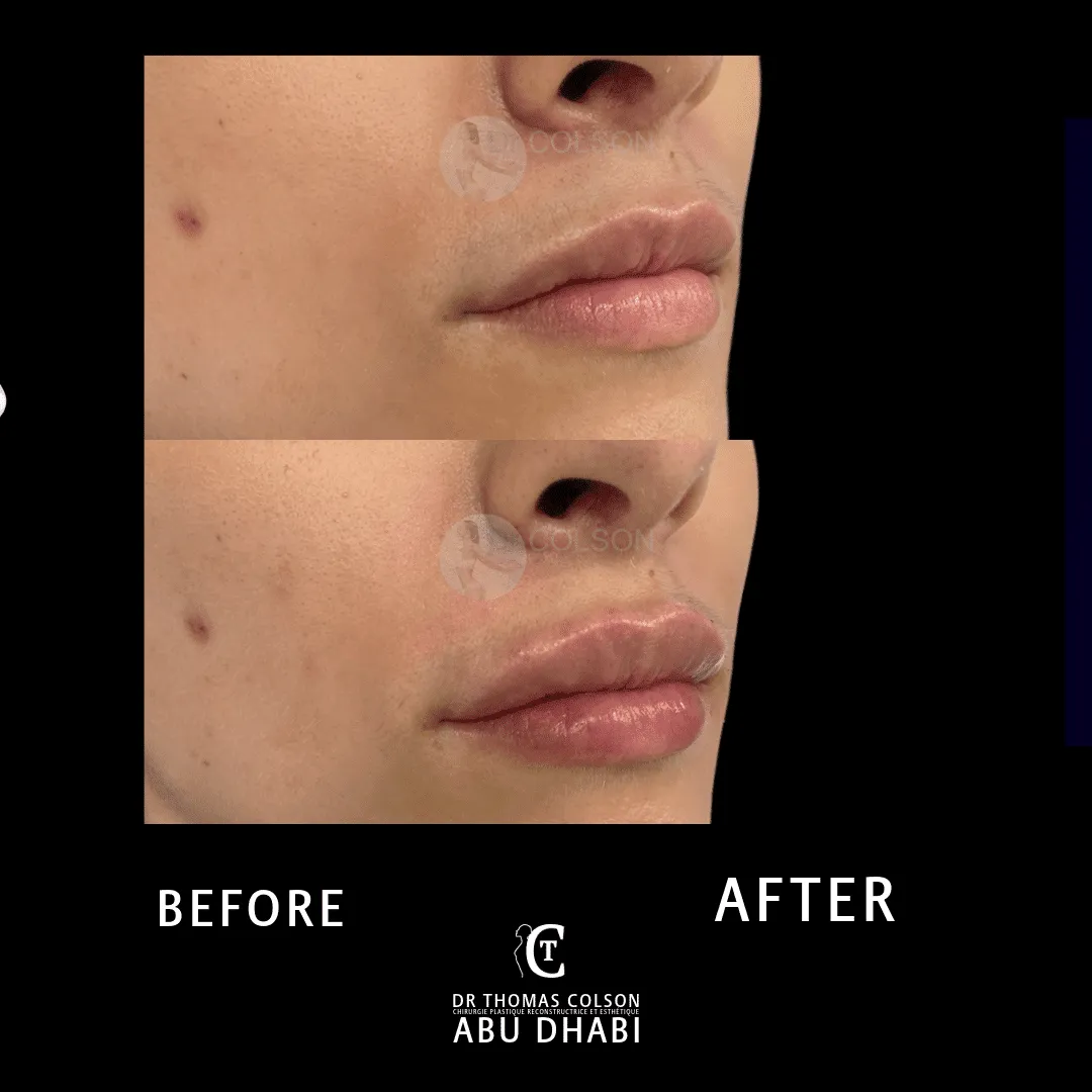 مقارنة فوتوغرافية قبل وبعد، الفيلر الجلدي (Dermal Fillers)، لقطة مقرّبة للشفتين. الحالة LP-05.
