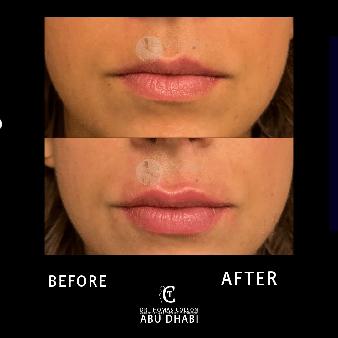 مقارنة فوتوغرافية قبل وبعد، الفيلر الجلدي (Dermal Fillers)، لقطة مقرّبة للشفتين. الحالة LP-06.