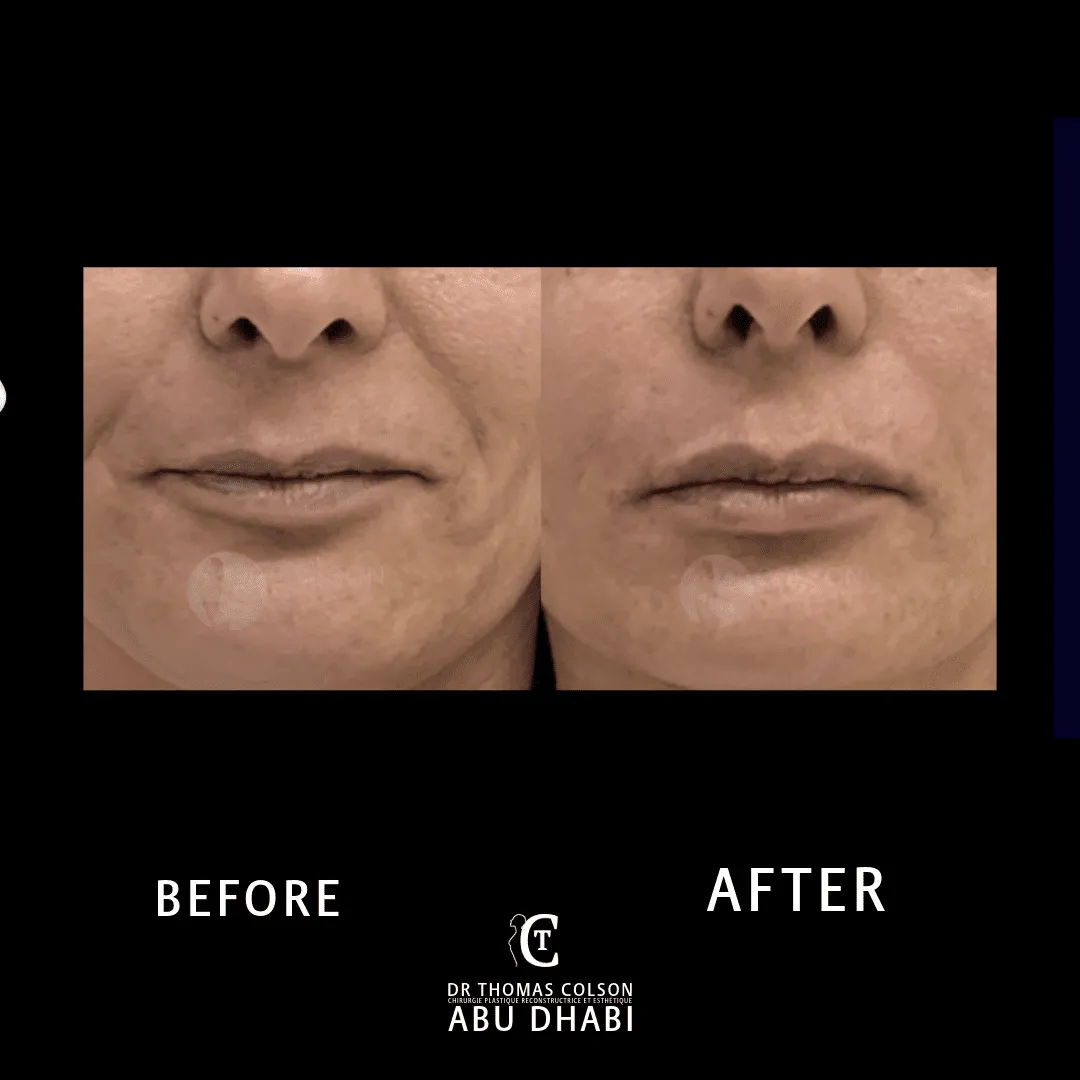 مقارنة فوتوغرافية قبل وبعد، الفيلر الجلدي (Dermal Fillers)، لقطة مقرّبة لوسط الوجه. الحالة NL-01.