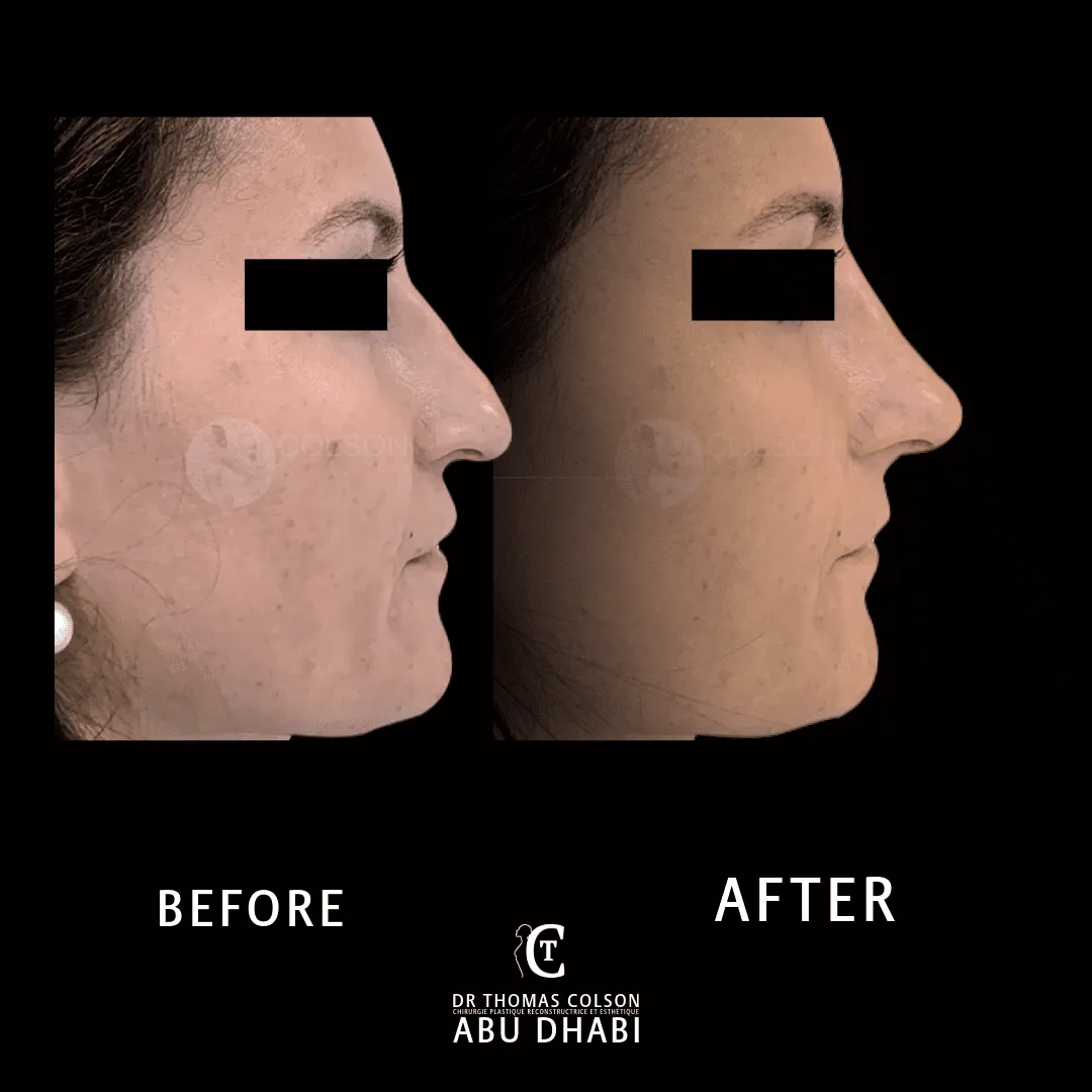 مقارنة فوتوغرافية قبل وبعد، الفيلر الجلدي (Dermal Fillers)، منظر جانبي. الحالة NF-01.