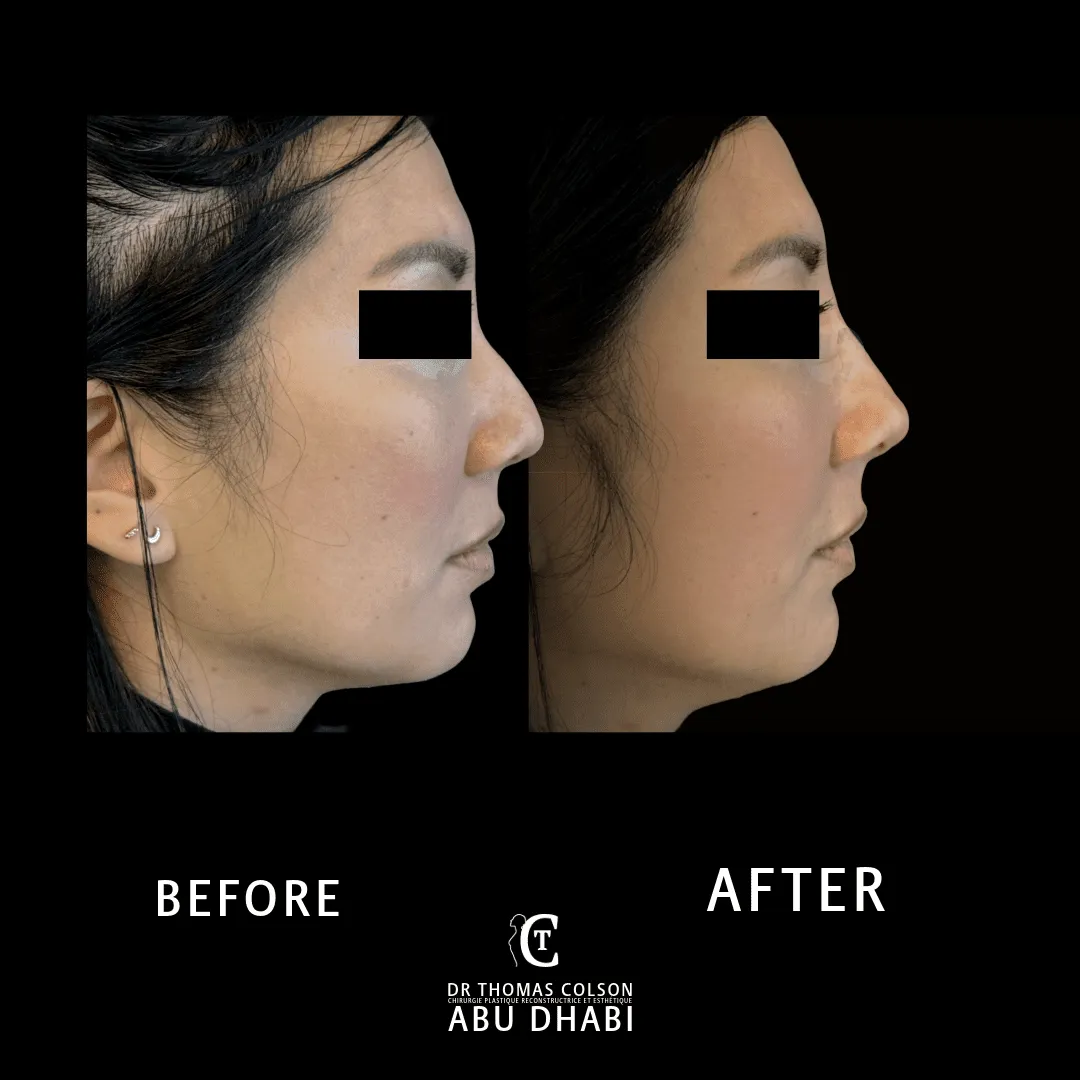 مقارنة فوتوغرافية قبل وبعد، الفيلر الجلدي (Dermal Fillers)، منظر جانبي. الحالة NF-02.