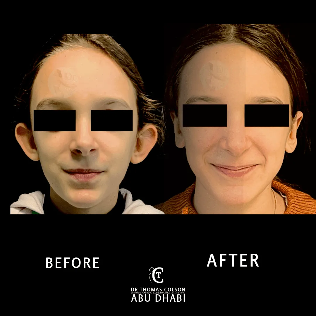 مقارنة فوتوغرافية قبل وبعد، تجميل الأذن (Otoplasty)، منظر أمامي. الحالة OT-01.