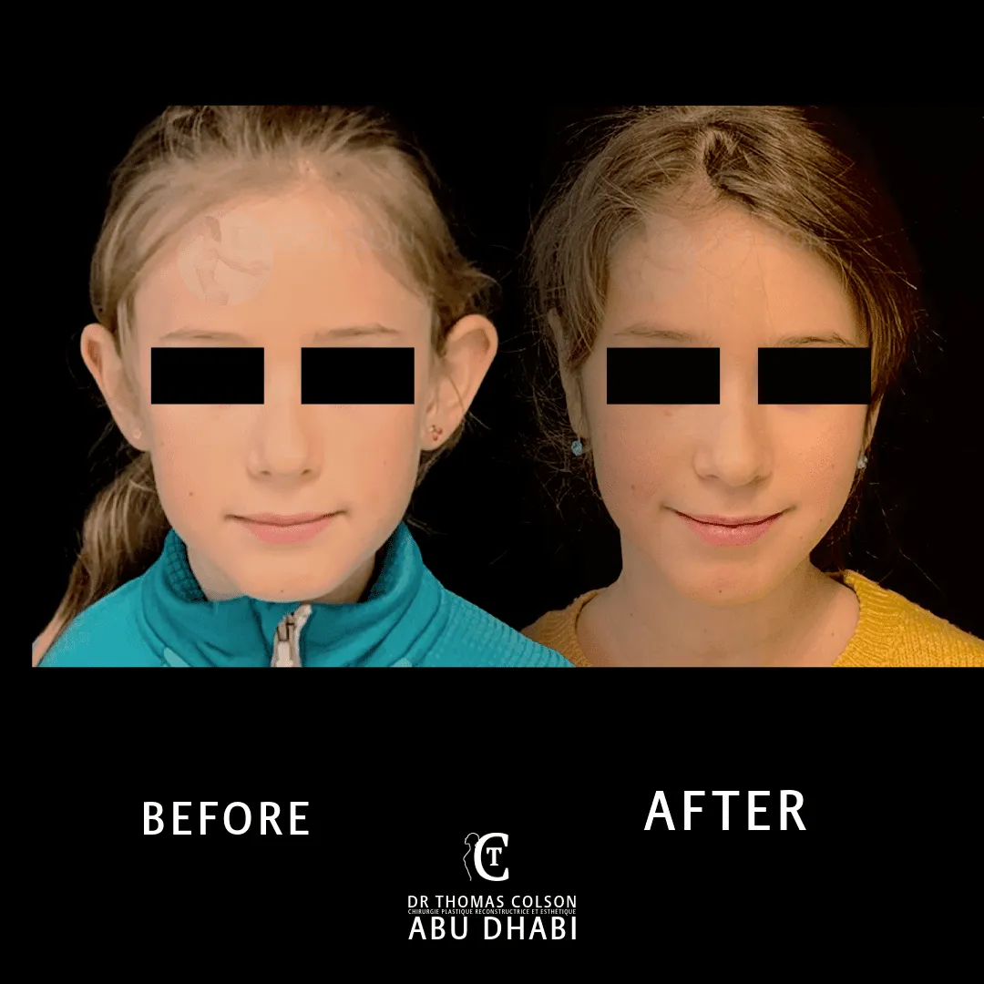 مقارنة فوتوغرافية قبل وبعد، تجميل الأذن (Otoplasty)، منظر أمامي. الحالة OT-02.