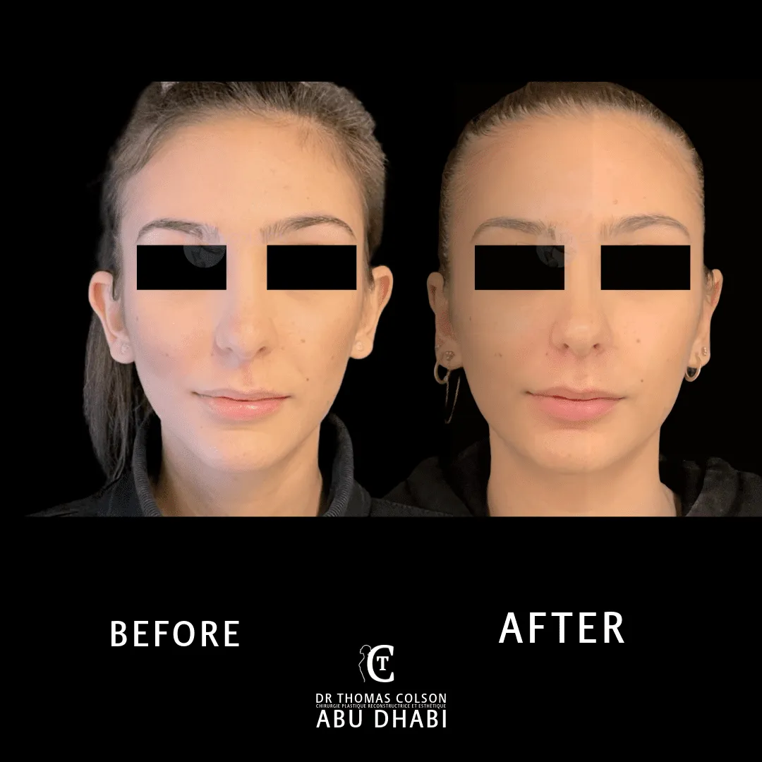 مقارنة فوتوغرافية قبل وبعد، تجميل الأذن (Otoplasty)، منظر أمامي. الحالة OT-03.