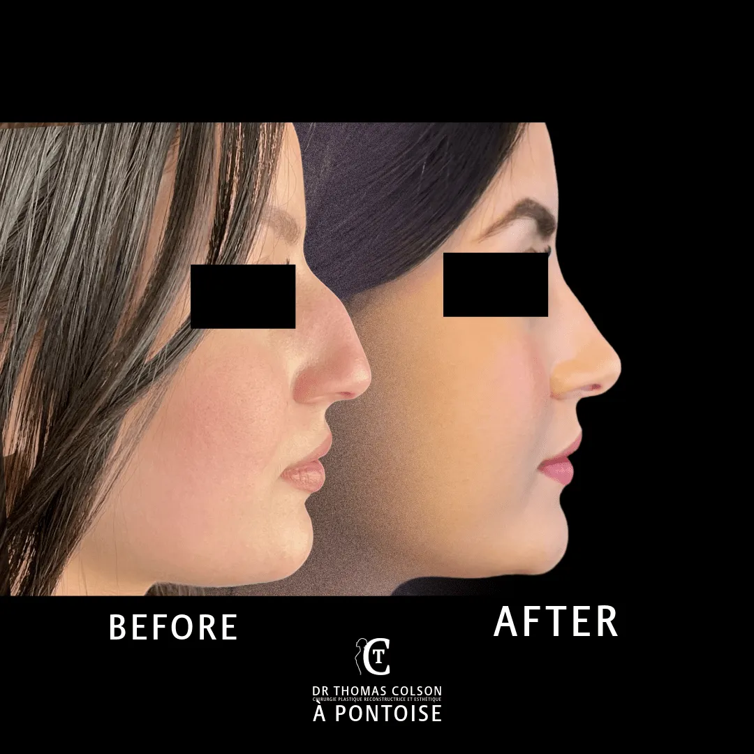 مقارنة فوتوغرافية قبل وبعد، تجميل الأنف (Rhinoplasty)، منظر جانبي. الحالة RH-01.