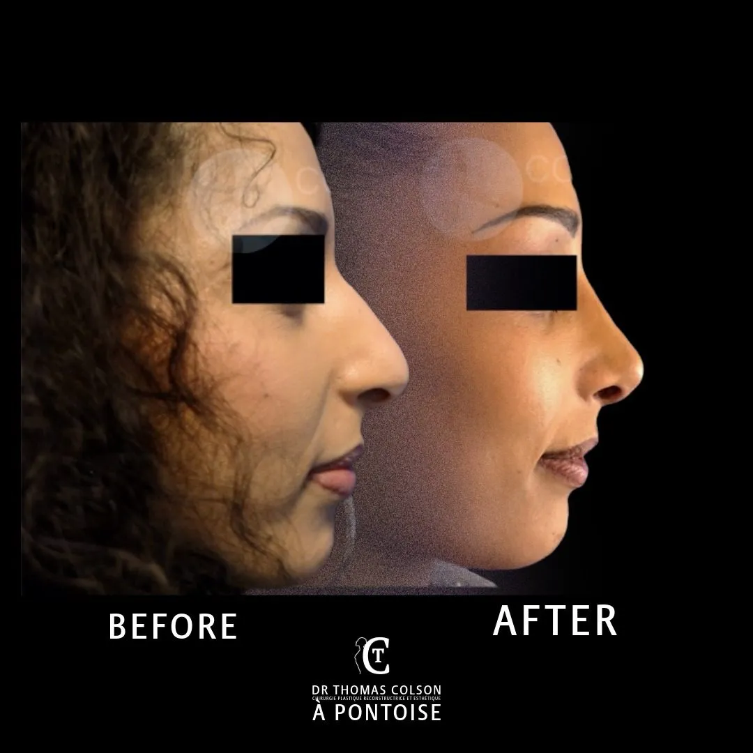 مقارنة فوتوغرافية قبل وبعد، تجميل الأنف (Rhinoplasty)، منظر جانبي. الحالة RH-02.