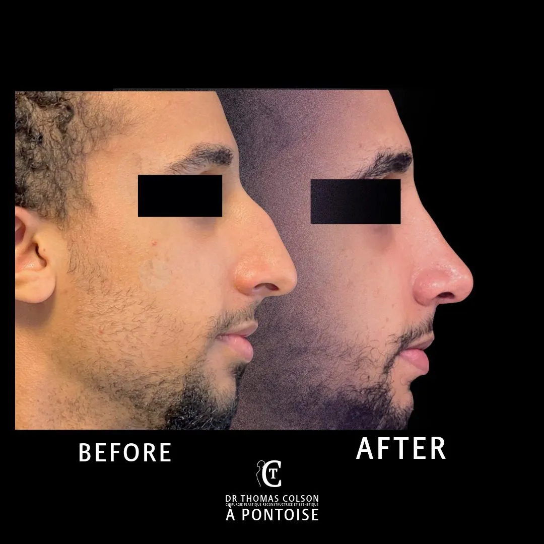 مقارنة فوتوغرافية قبل وبعد، تجميل الأنف (Rhinoplasty)، منظر جانبي. الحالة RH-03.