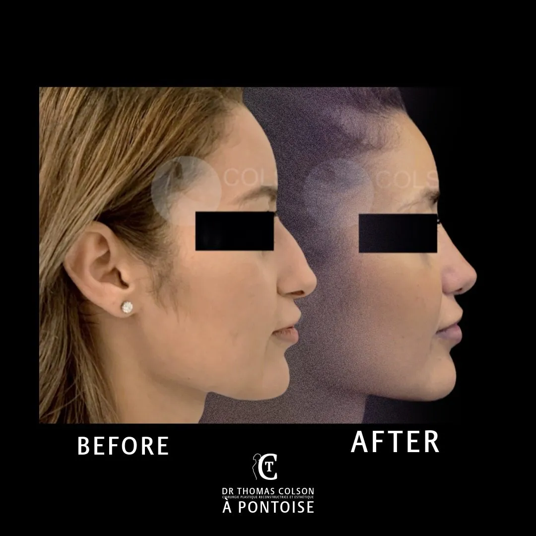 مقارنة فوتوغرافية قبل وبعد، تجميل الأنف (Rhinoplasty)، منظر جانبي. الحالة RH-04.