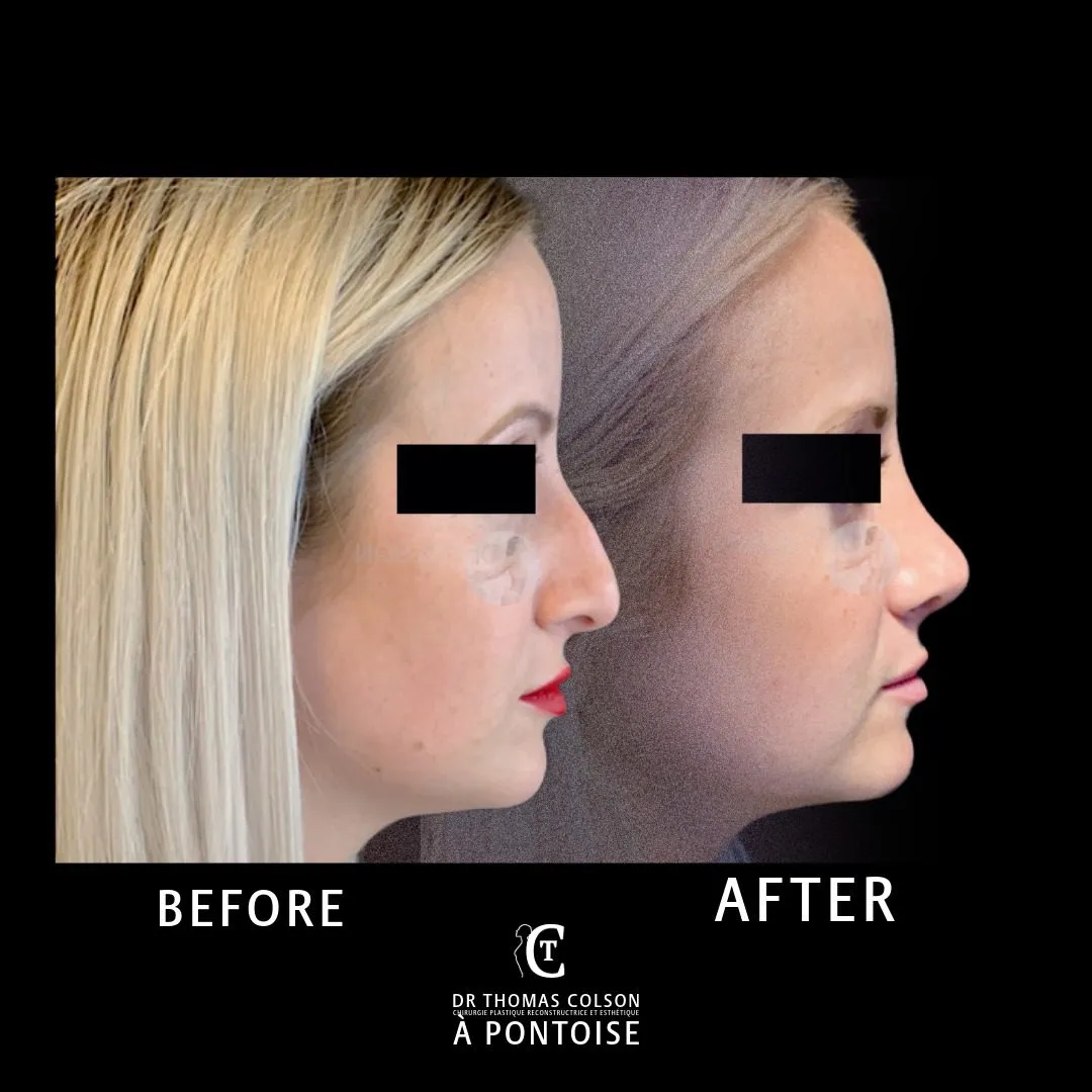 مقارنة فوتوغرافية قبل وبعد، تجميل الأنف (Rhinoplasty)، منظر جانبي. الحالة RH-05.