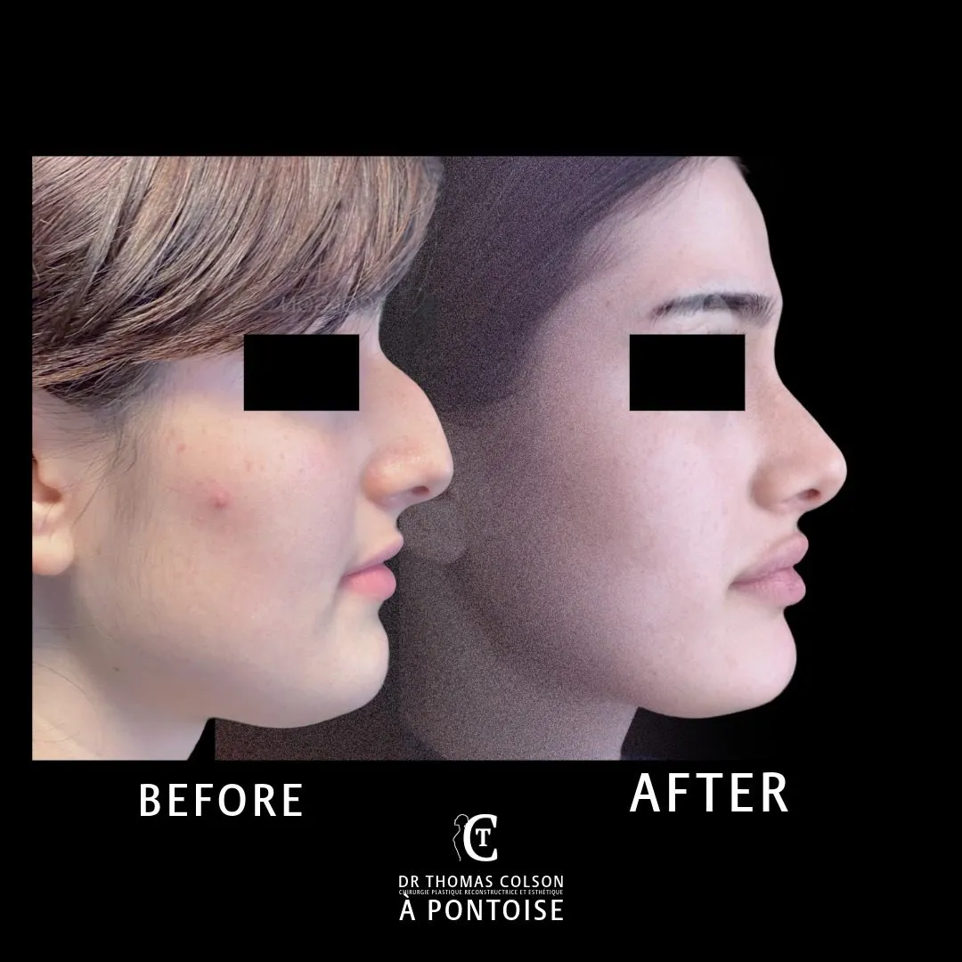 مقارنة فوتوغرافية قبل وبعد، تجميل الأنف (Rhinoplasty)، منظر جانبي. الحالة RH-06.