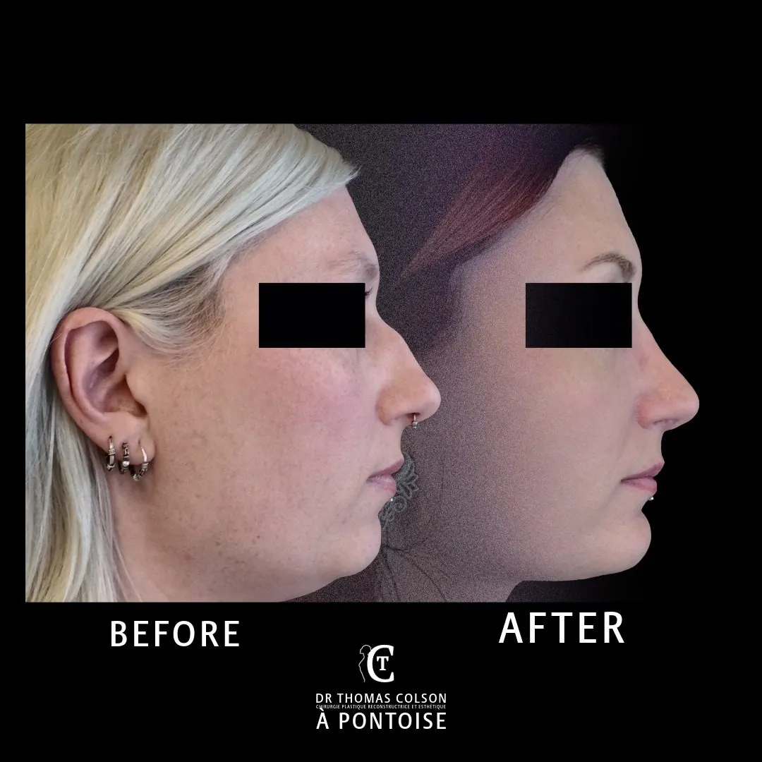 مقارنة فوتوغرافية قبل وبعد، تجميل الأنف (Rhinoplasty)، منظر جانبي. الحالة RH-07.