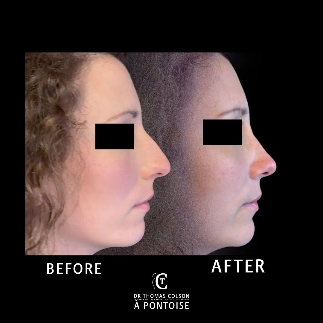مقارنة فوتوغرافية قبل وبعد، تجميل الأنف (Rhinoplasty)، منظر جانبي. الحالة RH-08.