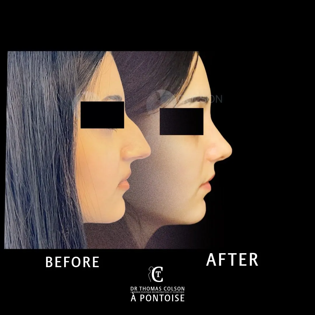 مقارنة فوتوغرافية قبل وبعد، تجميل الأنف (Rhinoplasty)، منظر جانبي. الحالة RH-09.