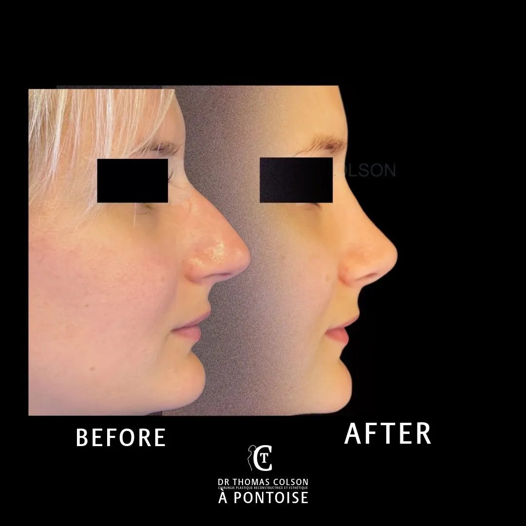 مقارنة فوتوغرافية قبل وبعد، تجميل الأنف (Rhinoplasty)، منظر جانبي. الحالة RH-10.