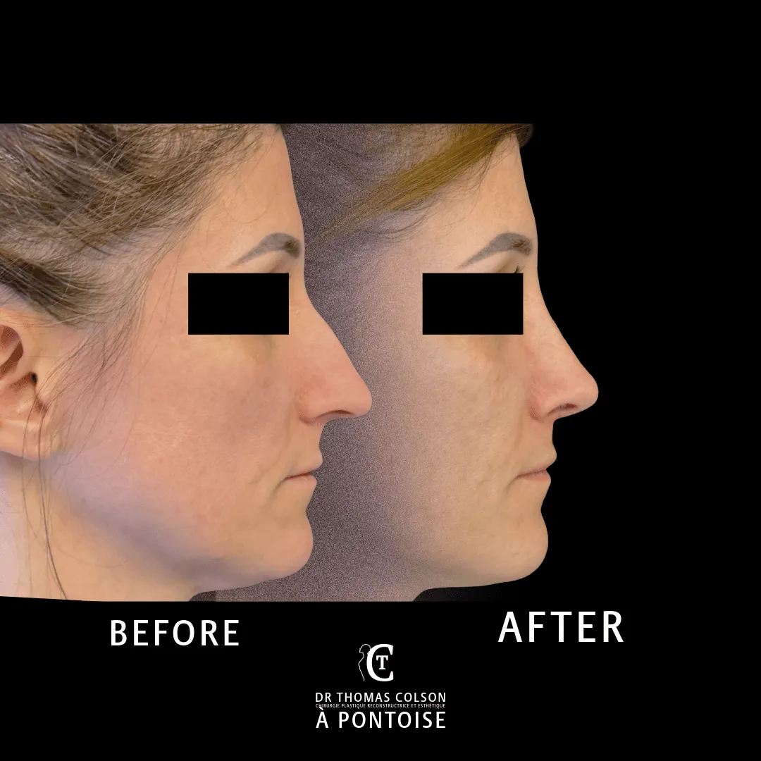 مقارنة فوتوغرافية قبل وبعد، تجميل الأنف (Rhinoplasty)، منظر جانبي. الحالة RH-11.