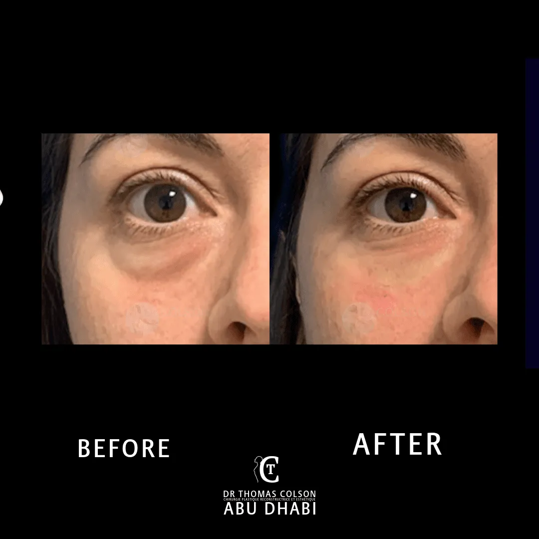 مقارنة فوتوغرافية قبل وبعد، الفيلر الجلدي (Dermal Fillers)، لقطة مقرّبة للجفون. الحالة TT-01.