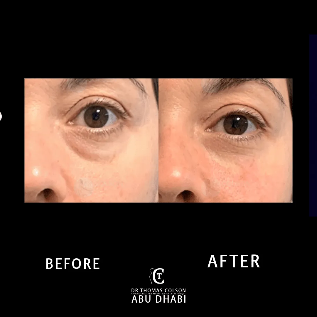 مقارنة فوتوغرافية قبل وبعد، الفيلر الجلدي (Dermal Fillers)، لقطة مقرّبة للجفون. الحالة TT-02.