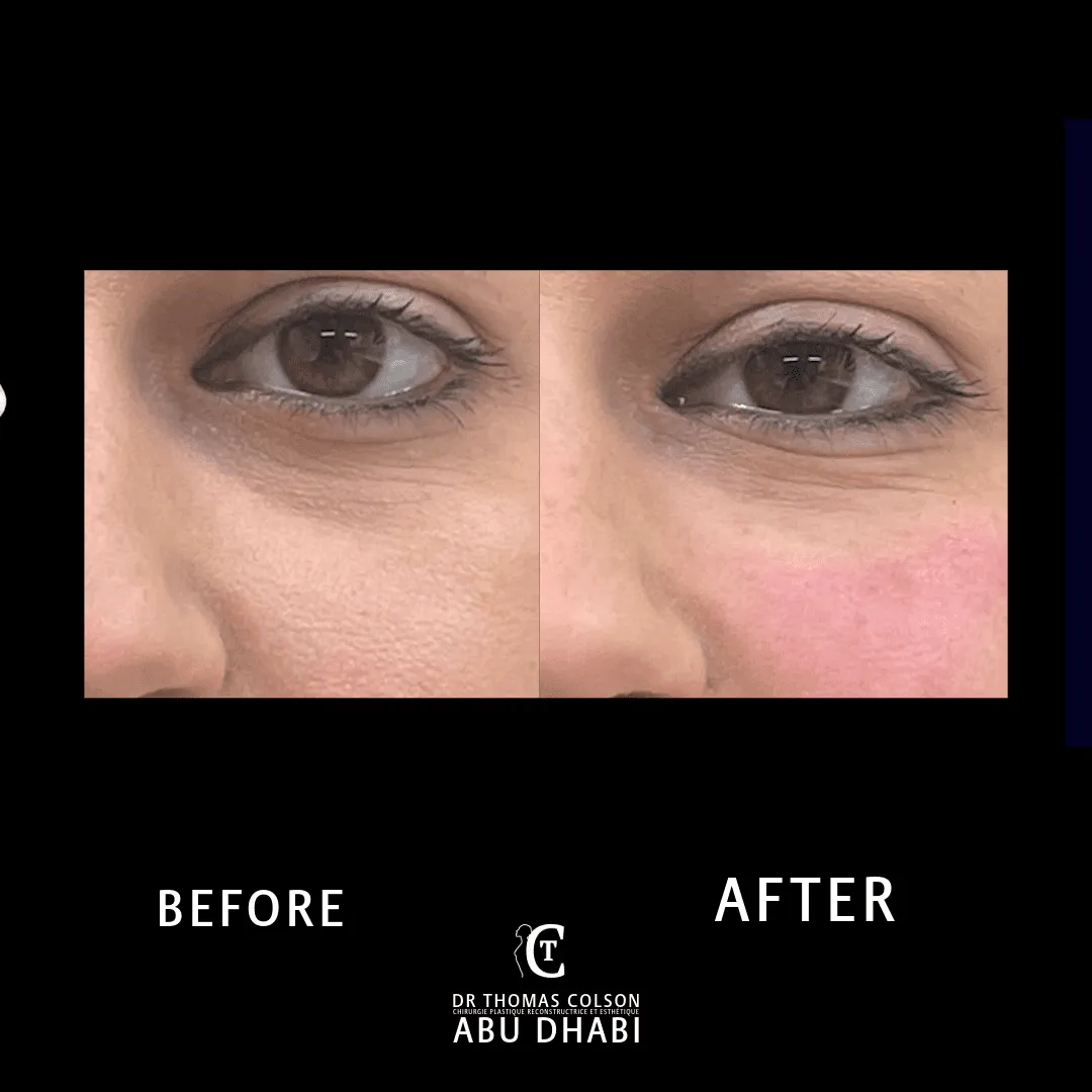 مقارنة فوتوغرافية قبل وبعد، الفيلر الجلدي (Dermal Fillers)، لقطة مقرّبة للجفون. الحالة TT-03.