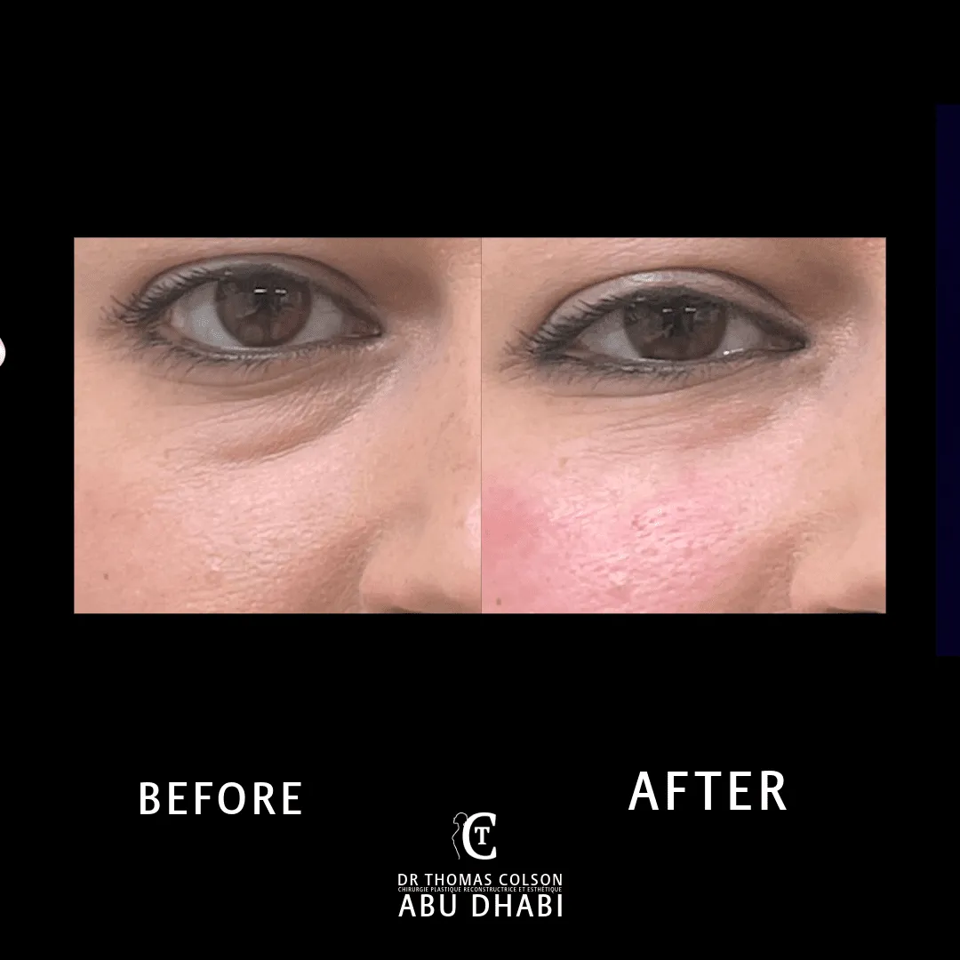 مقارنة فوتوغرافية قبل وبعد، الفيلر الجلدي (Dermal Fillers)، لقطة مقرّبة للجفون. الحالة TT-04.